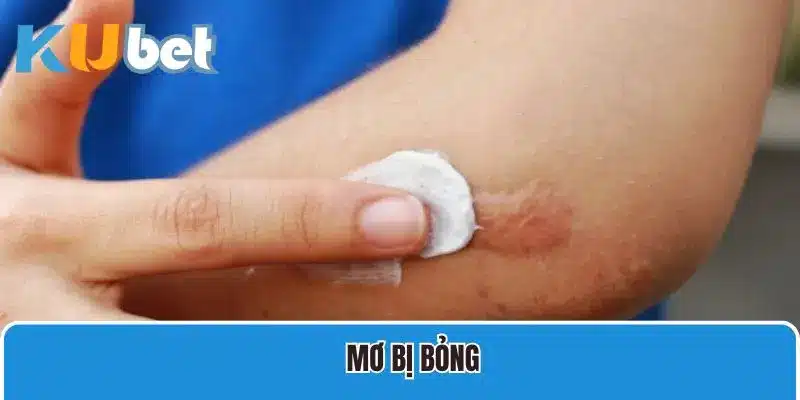 Mơ bị bỏng